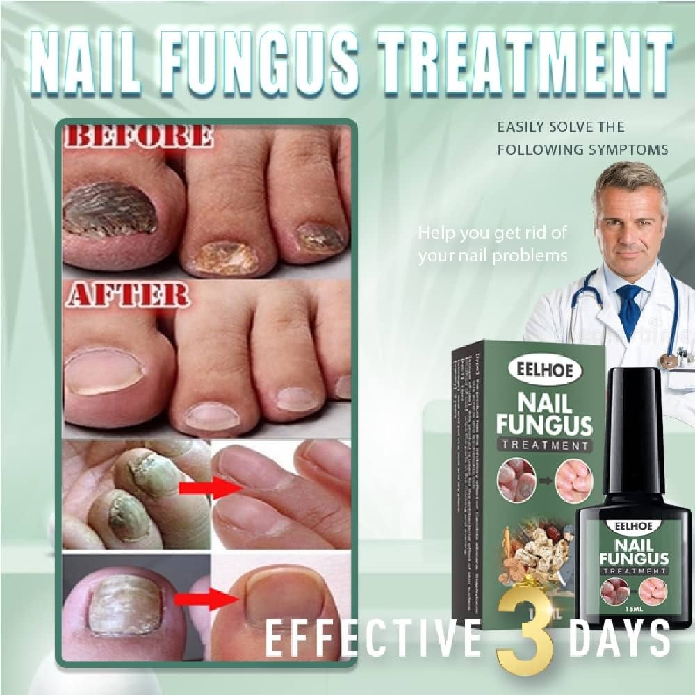 FAST NAIL FUNGUS TREATMENTS NAIL REPAIR ESSENCES SERUM