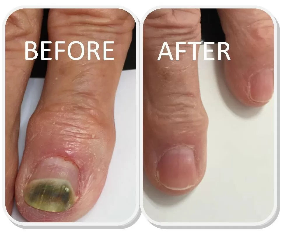 FAST NAIL FUNGUS TREATMENTS | NAIL REPAIR ESSENCES SERUM